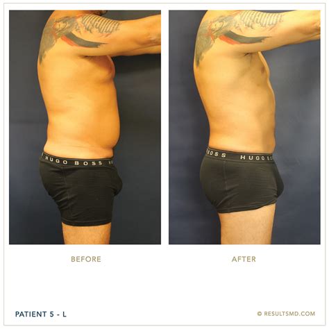 male liposuction miami|Best Liposuction Miami FL